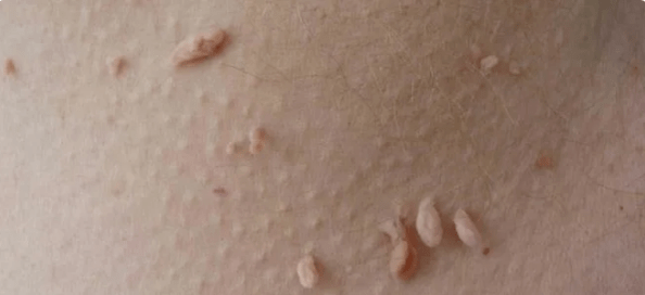 Način prijenosa HPV -a