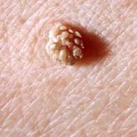 humani papiloma virus na koži