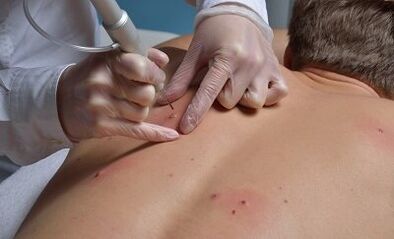 načini uklanjanja papiloma