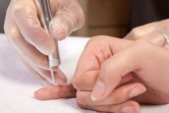 kako se riješiti papiloma na tijelu