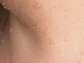 razlozi za pojavu papiloma na tijelu