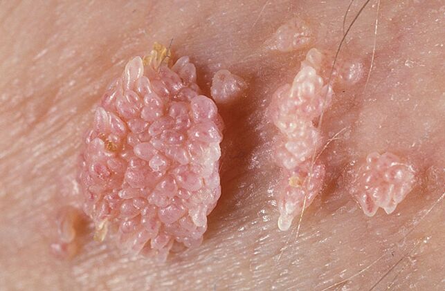 Papiloma je benigna tumorska formacija kože i sluznice bradavičaste prirode