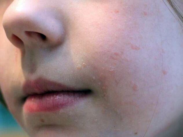 Ravne bradavice na licu najčešće se pojavljuju u adolescenciji