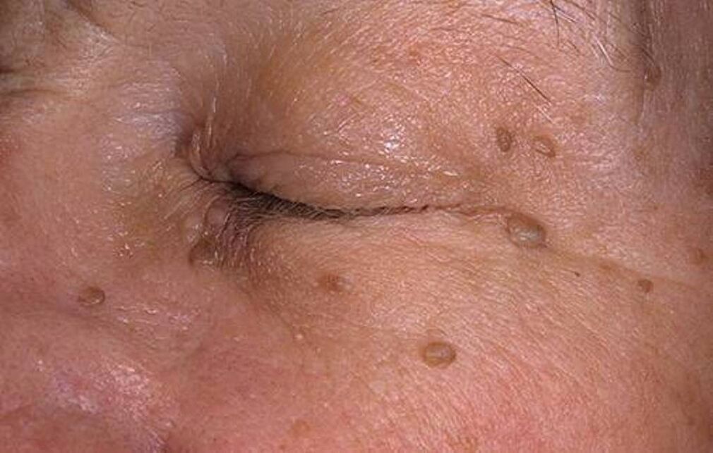 Papilomi na koži lica